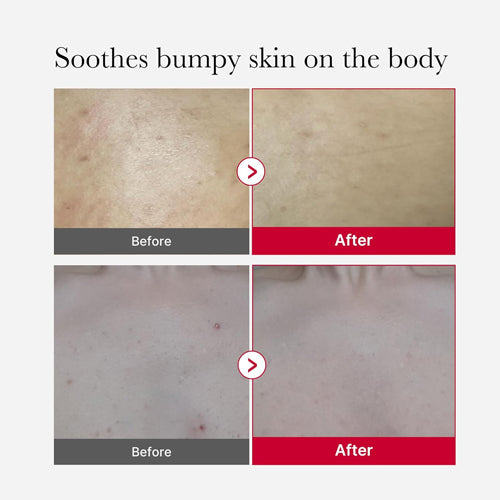 Red Acne Body Peeling Shot 2.0