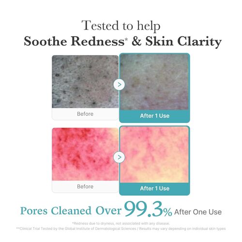 Azelaic Acid Niacinamide Deep Clean Foam Cleanser