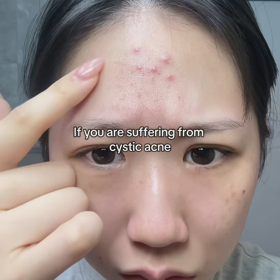 My breakout routine pt.2 #acneproneskin #skincaretips #koreanskincare #kbeauty #dralthea #anua #dralthea345cream #anuaazelaicacidserum #azelaicacid 
