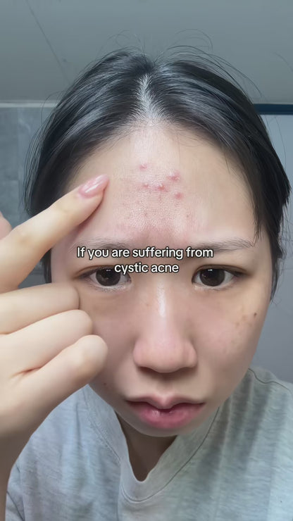 My breakout routine pt.2 #acneproneskin #skincaretips #koreanskincare #kbeauty #dralthea #anua #dralthea345cream #anuaazelaicacidserum #azelaicacid 