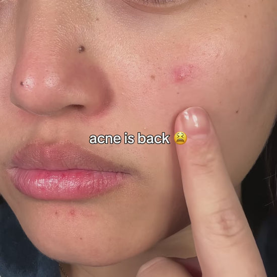 This green serum is a game changer!! Would you try it ??? @anua_global @anua_ambassadors  . . . . . . #azelaicacid #anuaazelaicacidserum #kbeauty #acnetreatment #fypskincare 