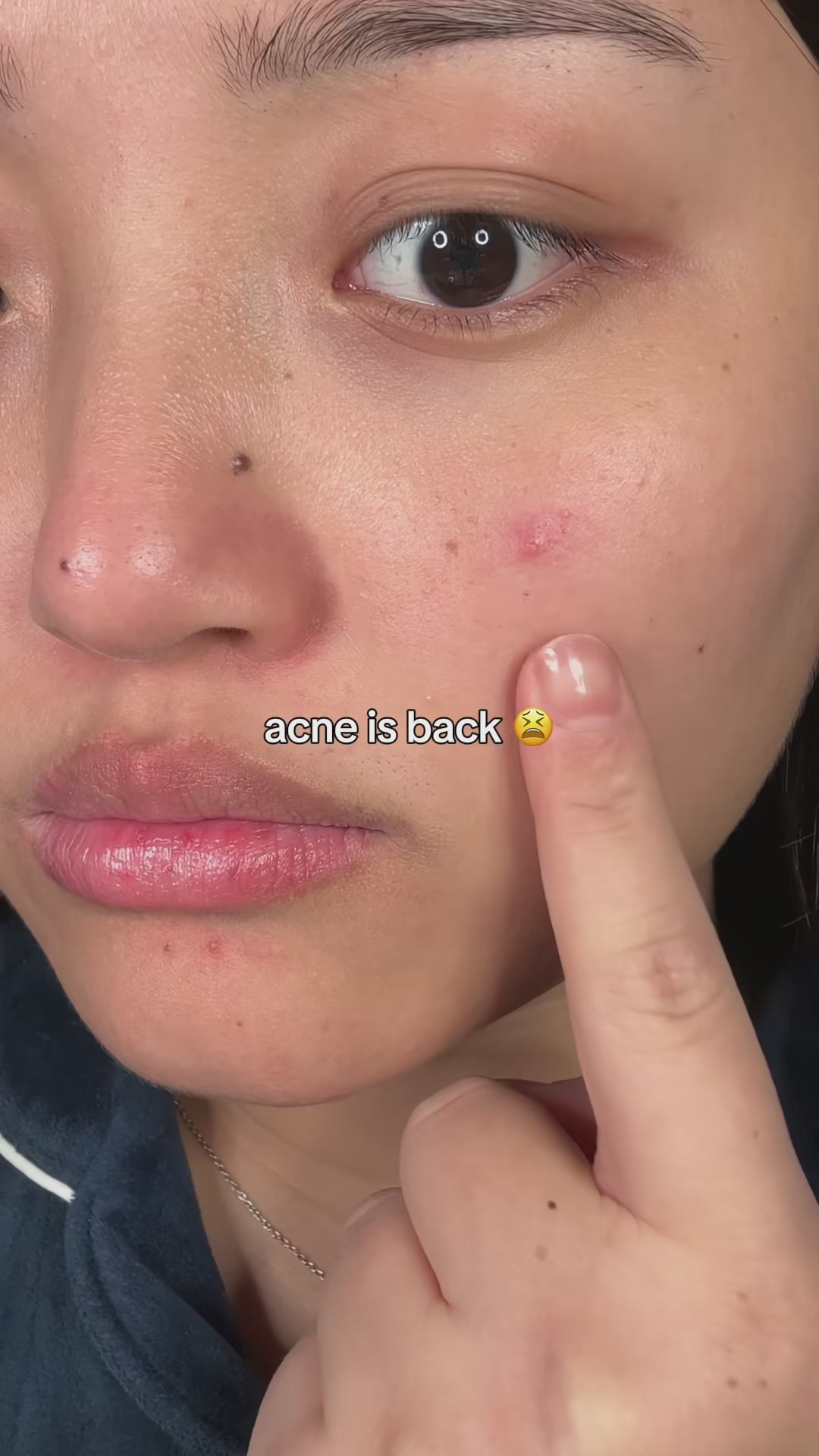 This green serum is a game changer!! Would you try it ??? @anua_global @anua_ambassadors  . . . . . . #azelaicacid #anuaazelaicacidserum #kbeauty #acnetreatment #fypskincare 