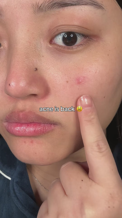 This green serum is a game changer!! Would you try it ??? @anua_global @anua_ambassadors  . . . . . . #azelaicacid #anuaazelaicacidserum #kbeauty #acnetreatment #fypskincare 